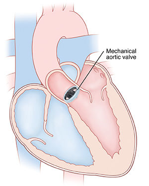 Front view cross section of heart showing mechanical aortic valve in place.