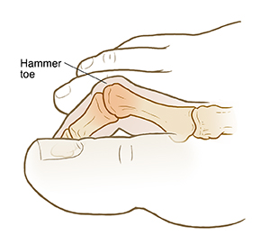 Side view of foot showing hammer toe.