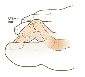 Side view of foot showing claw toe.