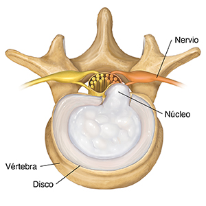 Vista superior de una vértebra lumbar que muestra un disco herniado.
